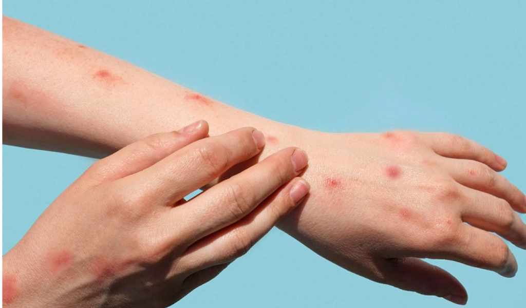Patologías que parecían erradicadas, como el sarampión y la leishmaniasis, vuelven a representar un problema de salud pública en Salta