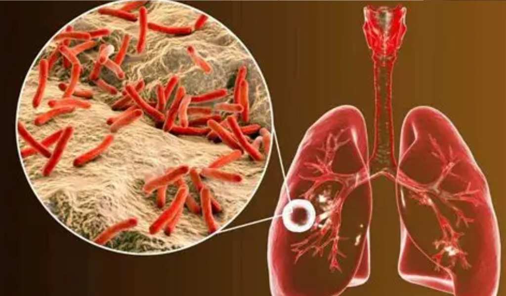 El sistema penitenciario de Salta registra 19 casos de tuberculosis en distintas cárceles: "Un preso de 25 años está grave"
