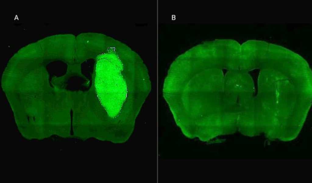 Avance médico: Científicos del CONICET desarrollaron una nueva estrategia para frenar tumores cerebrales cancerígenos