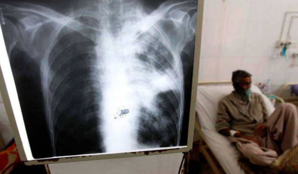Salta es la provincia argentina con más contagios y muertes por tuberculosis: “Desde Bolivia llegan a nuestro país casos muy  graves"