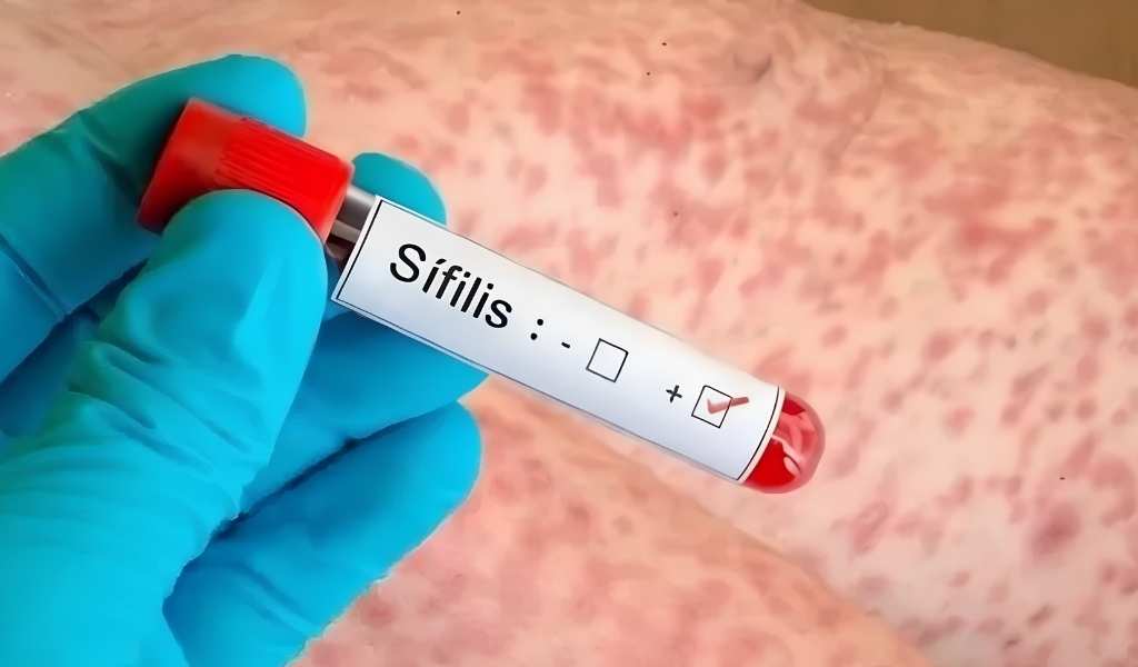 Preocupación en el área de Salud: advierten por la suba de contagios de sífilis en Salta