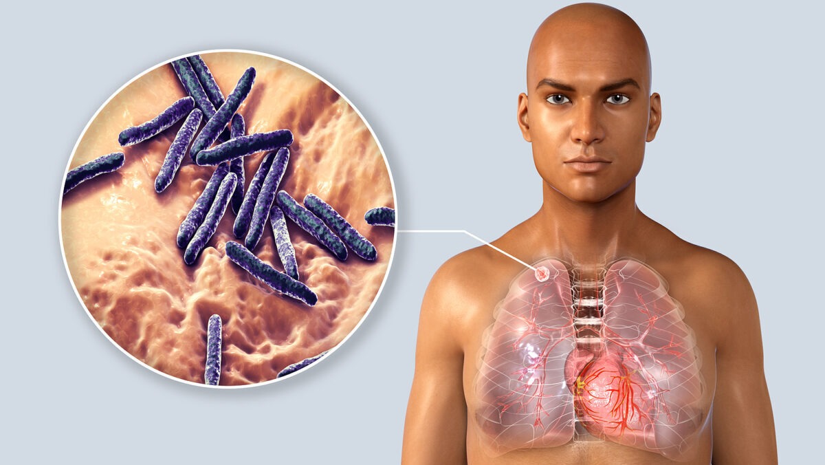 Confirman en Salta un caso de tuberculosis en una alumna de un colegio