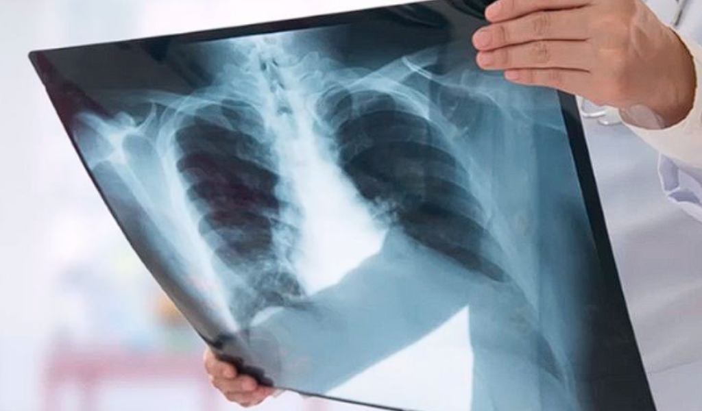 Salta es la provincia argentina con más contagios y muertes por tuberculosis: “Desde Bolivia llegan a nuestro país casos muy  graves"