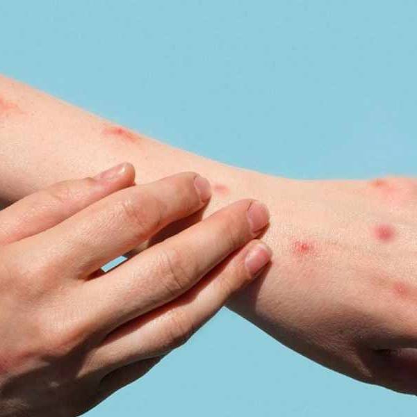 Patologías que parecían erradicadas, como el sarampión y la leishmaniasis, vuelven a representar un problema de salud pública en Salta