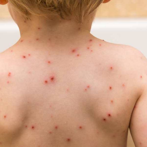 En Salta se registraron 509 casos de varicela en lo que va del 2025: 