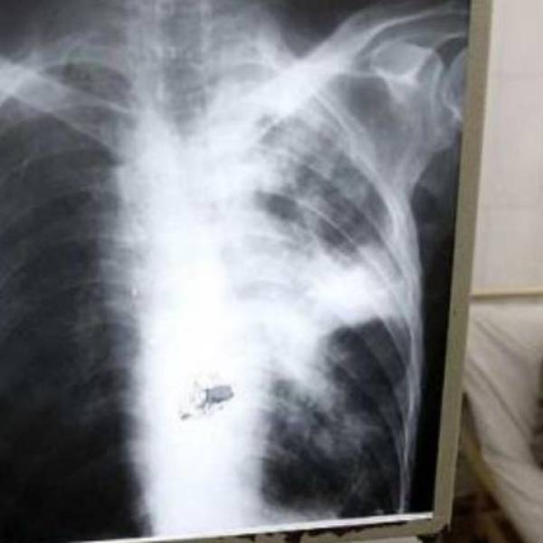 En Salta se registraron 400 casos de tuberculosis en lo que va del 2026