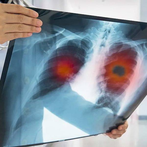 El ministro de Salud de Salta confirmó que actualmente son 19 los casos de tuberculosis detectados en cárceles de la provincia