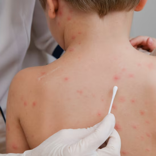 Argentina lanzó una alerta sanitaria por sarampión: Rastrean los contactos de la familia de turistas que cruzó el país con la infección