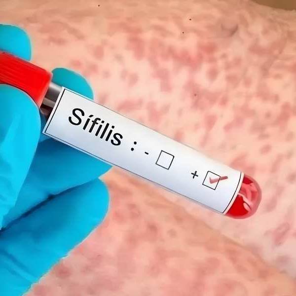 Preocupación en el área de Salud: advierten por la suba de contagios de sífilis en Salta