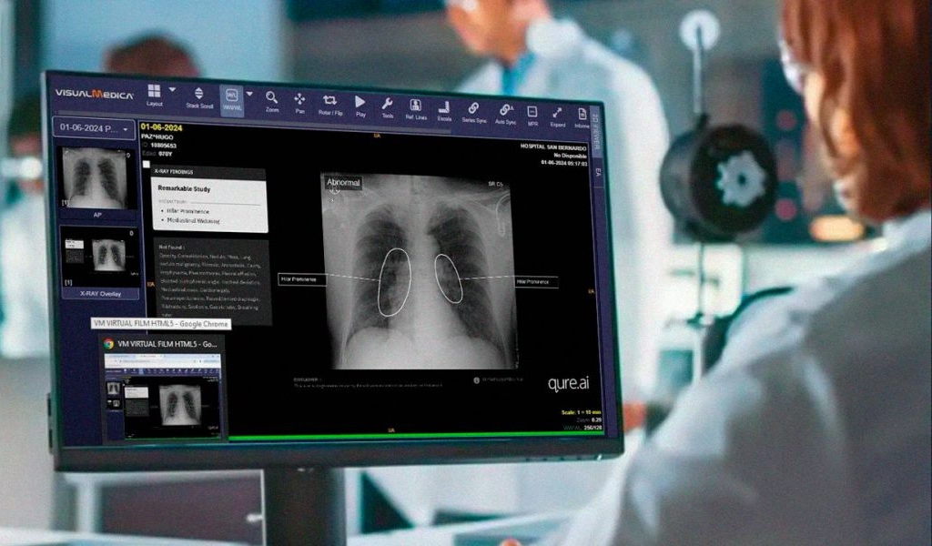 El hospital San Bernardo es pionero en  implementar Inteligencia Artificial para  detectar cáncer de pulmón