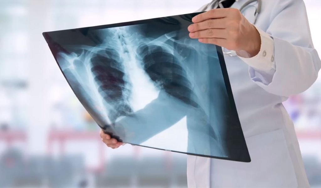 Diagnosticaron en Salta más de 900 casos de tuberculosis en 2024