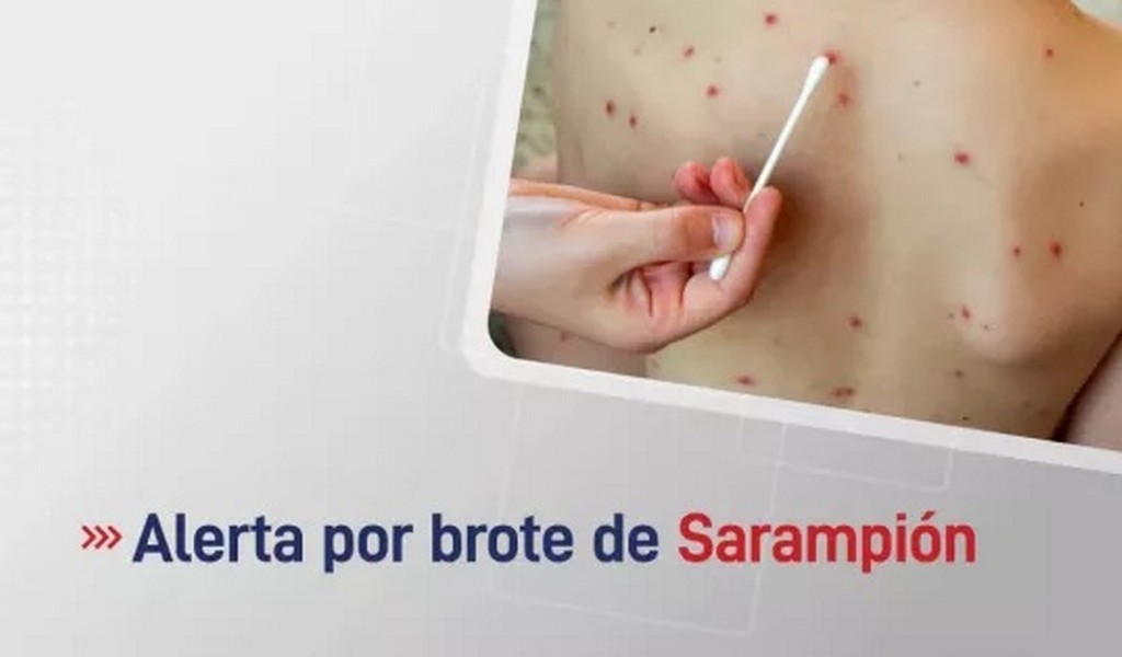 Se emitió una alerta epidemiológica por un brote de sarampión en el país